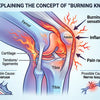 The Burning Knee Understanding Causes Relief and Help
