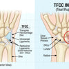 TFCC Injury Understanding and Managing Wrist Pain