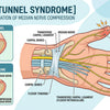 Carpal Tunnel Syndrome Understanding Symptoms and Management