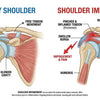 Understanding Shoulder Impingement Comprehensive Guide