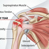 Understanding a Rotator Cuff Tear Symptoms Causes Recovery
