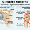 Shoulder Arthritis Understanding Symptoms Treatment Options