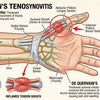 De Quervain's Tenosynovitis Understanding Symptoms and Management