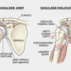 Understanding Shoulder Dislocation Causes Treatment Recovery