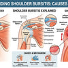 Understanding Shoulder Bursitis Causes Symptoms Relief
