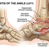 Understanding Osteoarthritis of the Ankle
