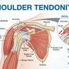 Shoulder Tendonitis Understanding Treatment and Recovery