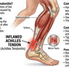Understanding Achilles Tendonitis