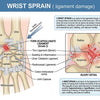 Wrist Sprain Understanding Treatment and Recovery